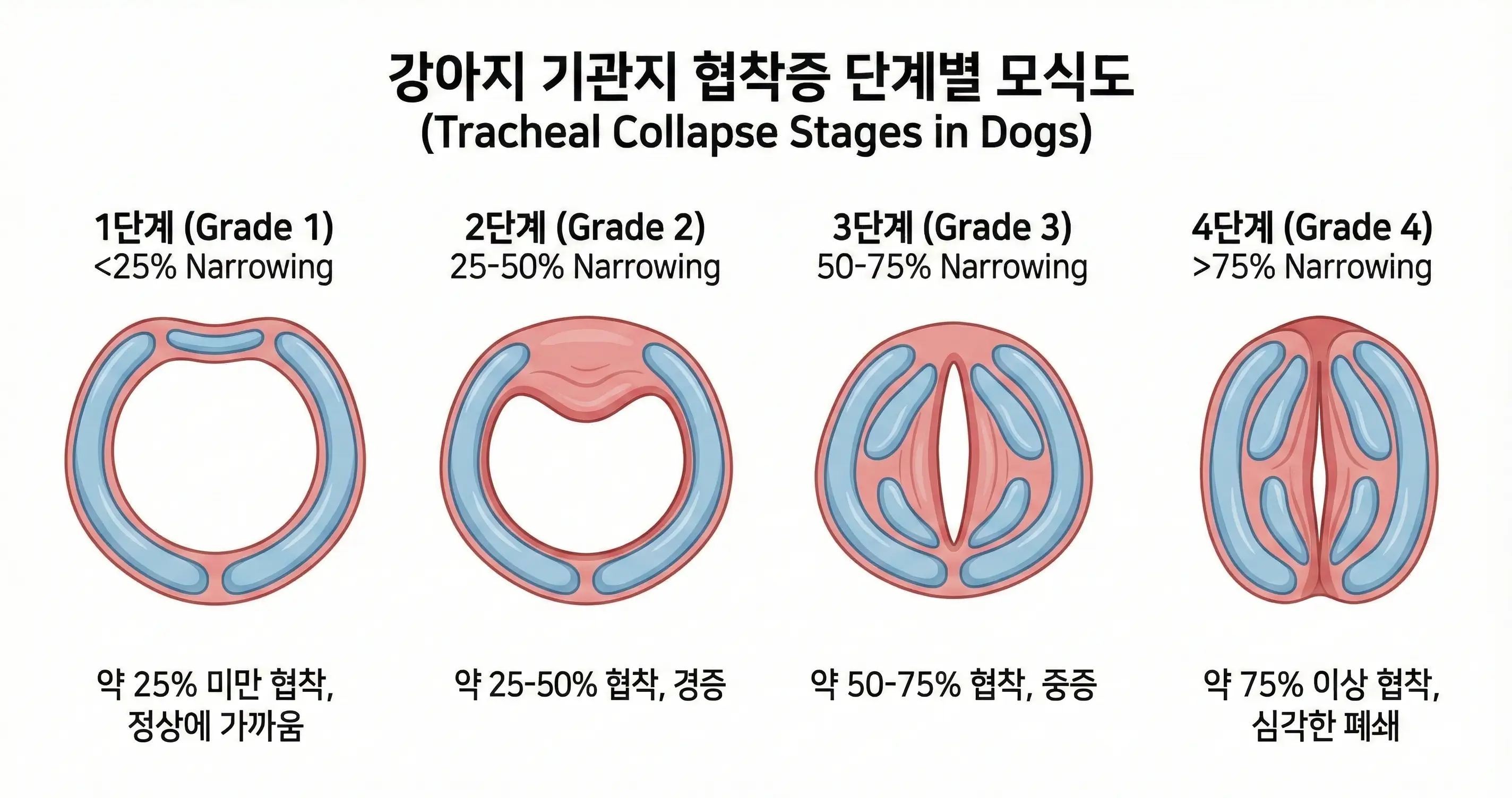 강아지 기관지 협착증의 1단계부터 4단계까지 기관지 단면이 좁아지는 정도를 나타내는 모식도