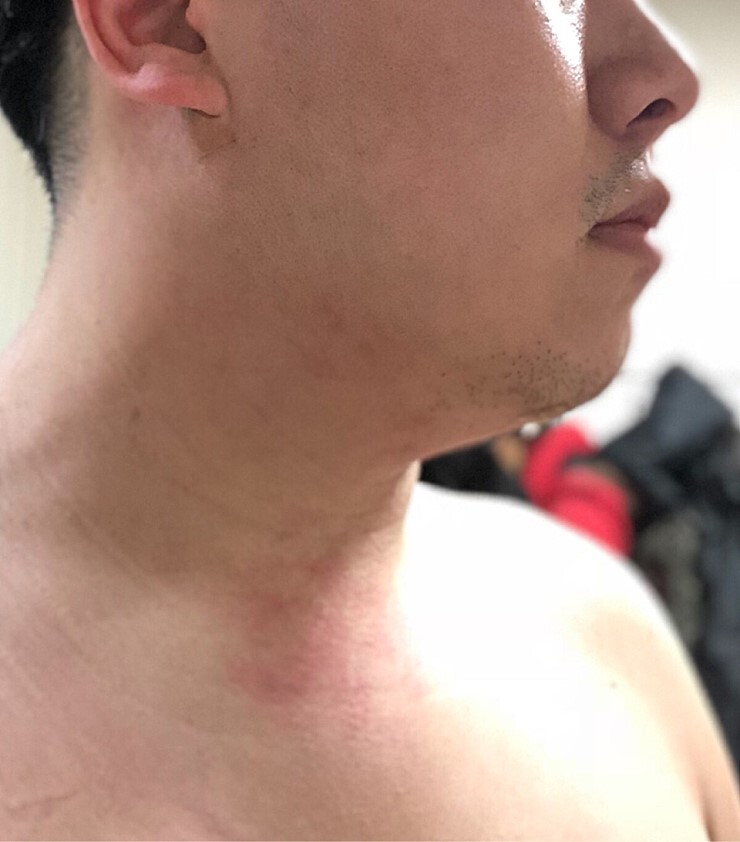 얼굴 지방흡입 후기