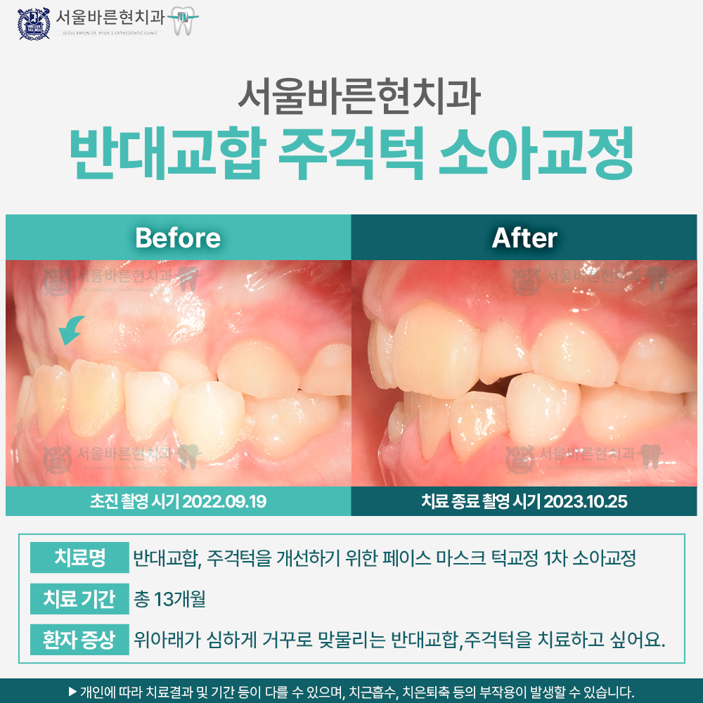 마린시티소아교정