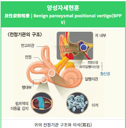 이석증증상 이석증 이석치환술 양성자세현훈 이석증치료방법 이석증재발