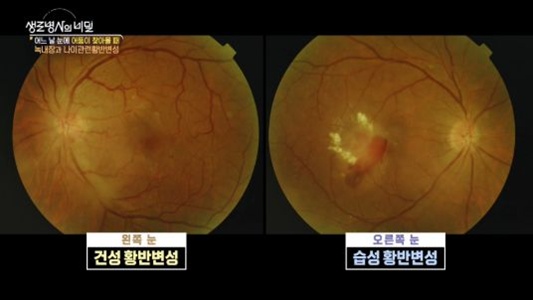 황반변성-생로병사의비밀