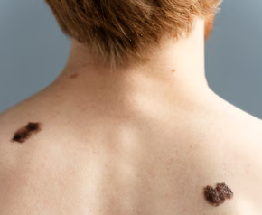 피부암 초기증상 2