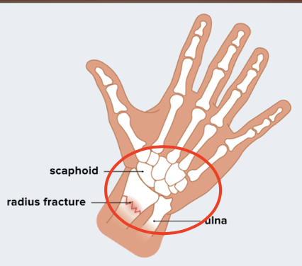 손목터널증후군