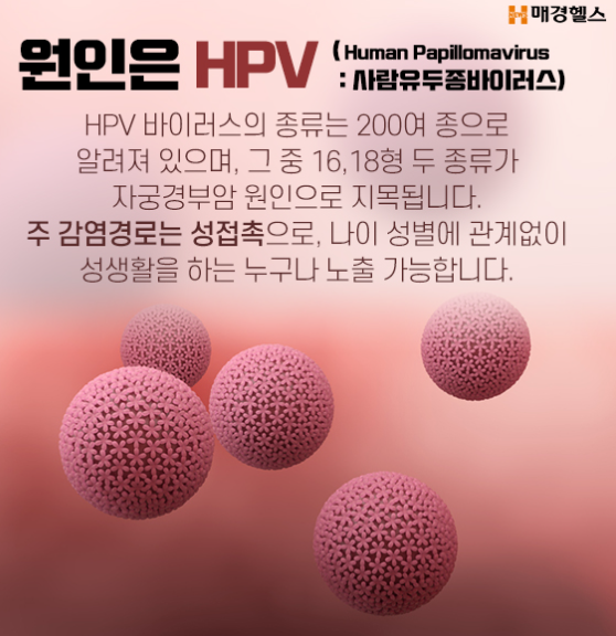 HPV 바이러스 인유종바이러스 원인
출처 : 매경헬스