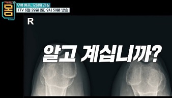 퇴행성관절염