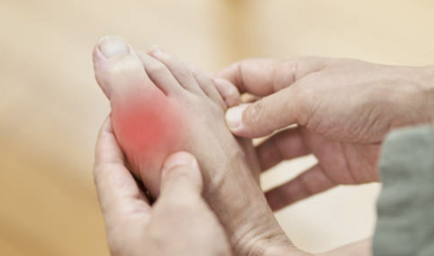 통풍 초기증상 치료법, 좋은 음식에 대한 모든 것 확인