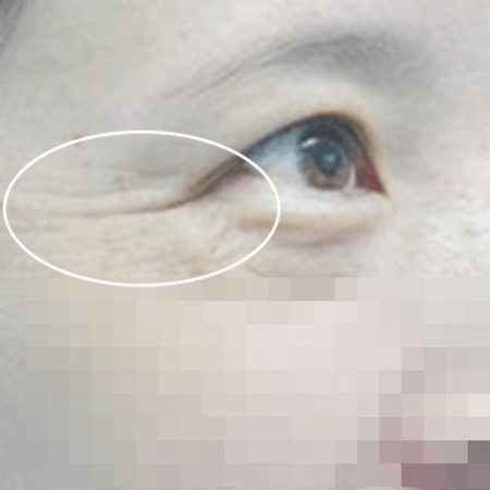 눈가보톡스 전 모습