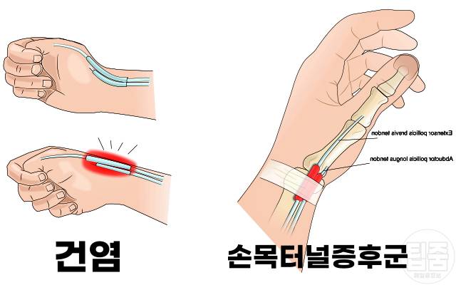손목 아플때 가는 병원 정형외과,건염