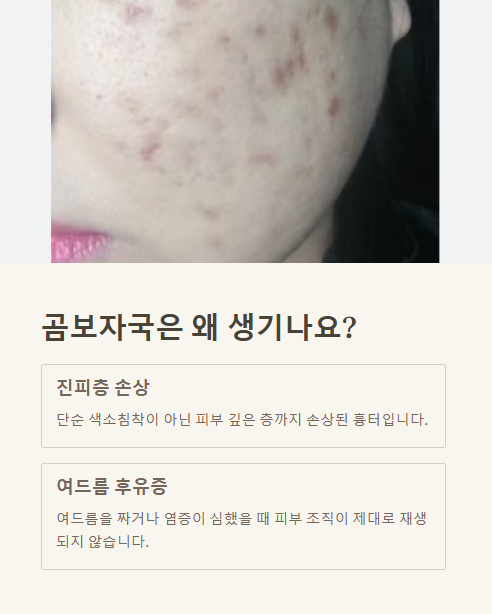 곰보자국은 왜 생기나요?