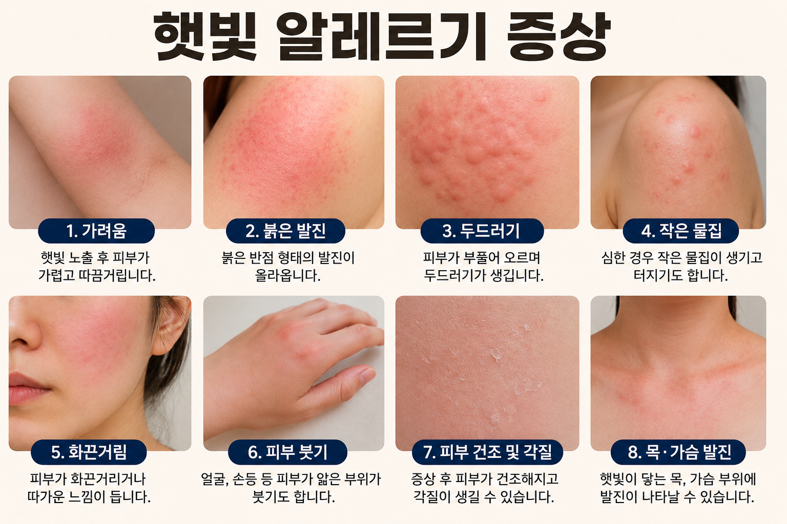 햇빛 알레르기 증상