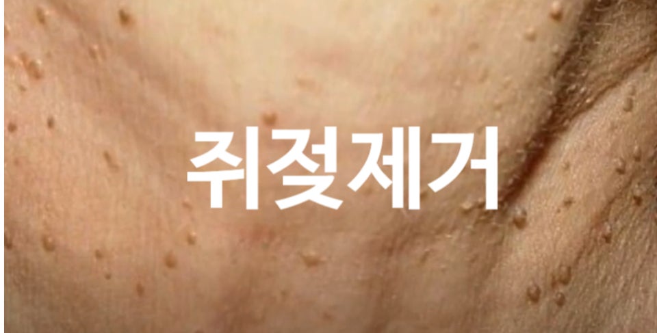 쥐젖 제거하기