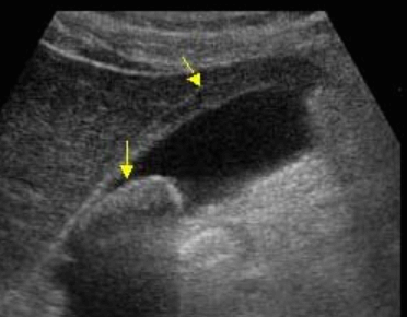 급성 담낭염 (Acute cholecystitis)
