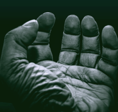 손가락 관절염 증상과 치료법