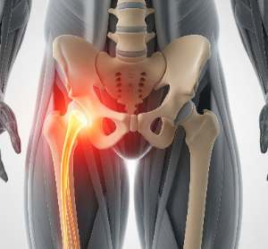 [고관절허벅지 통증]