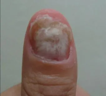 손톱이 갈라지는 이유 원인 증상 대처법_5