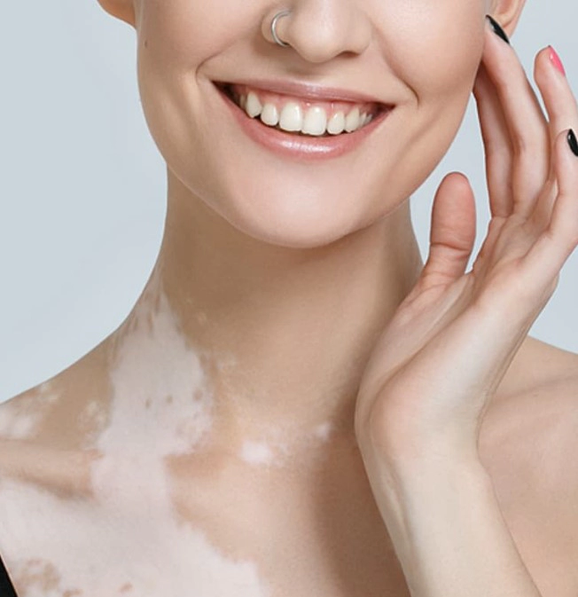 백반증 초기증상