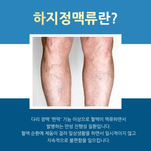 하지정맥류
