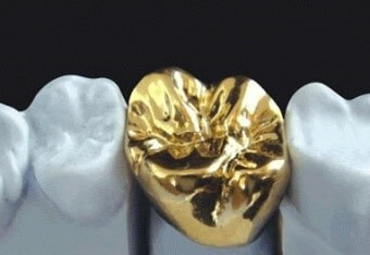 어금니를-금이빨로-대체하려는-모습