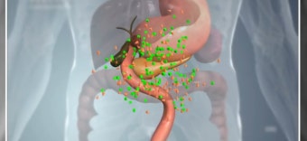 당뇨병과 췌장암의 관계