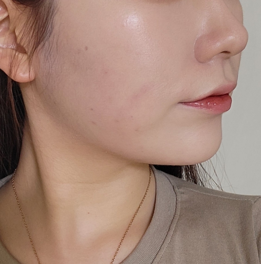 bbl 레이저 후기