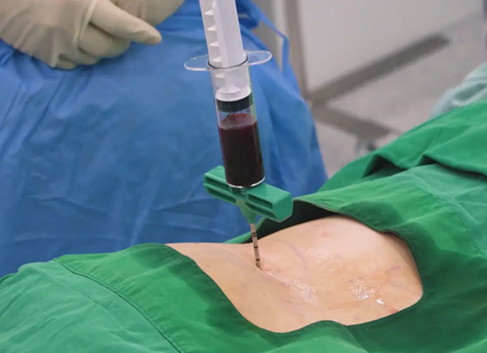 무릎줄기세포주사-치료중