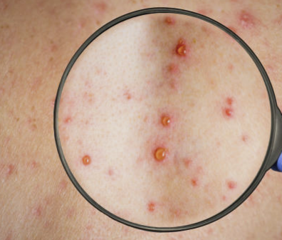 대상포진 초기증상 치료방법 예방법 총정리