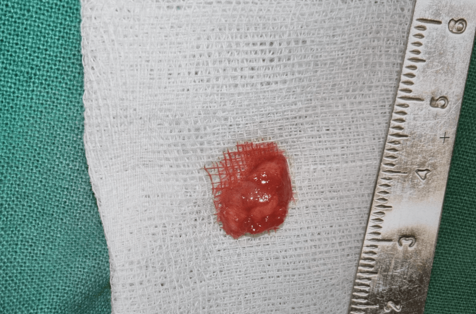 치아 뿌리 염증