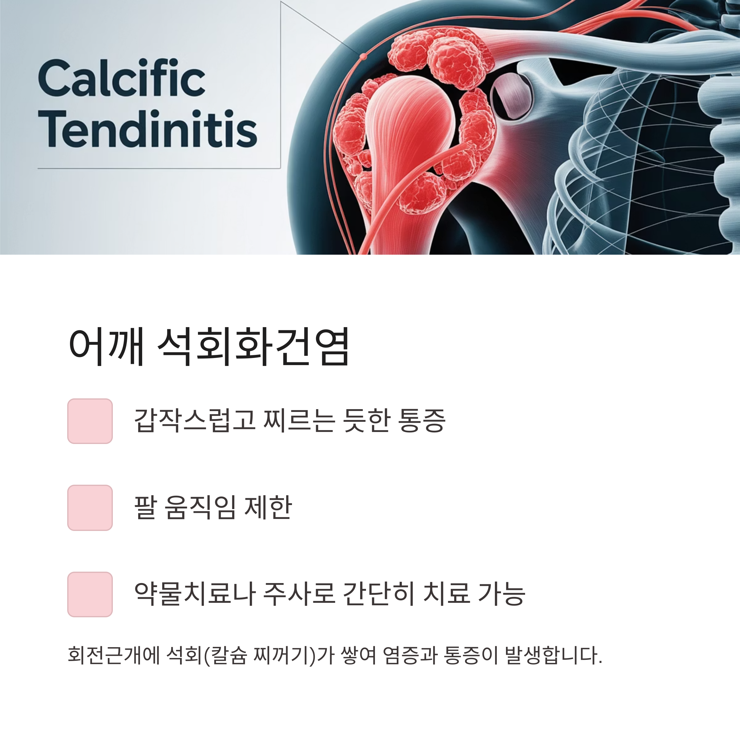 어깨 석회화건염의 원인과 증상을 나타낸 의학적 일러스트 및 치료 방법 요약