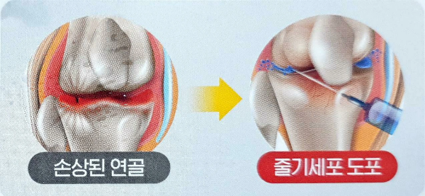 줄기세포로무릎치료를할수있다고