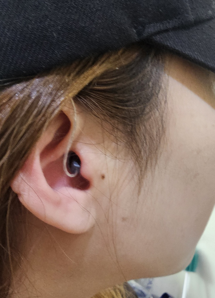 오픈형 보청기 착용 사진입니다