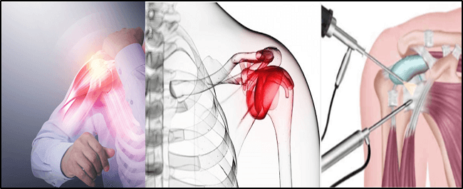 오십견 증상과 수술적 치료 이미지