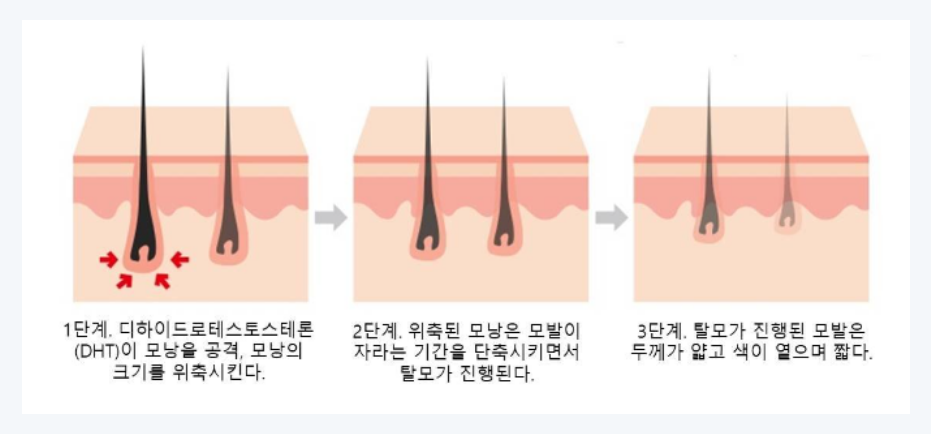 탈모의 과정