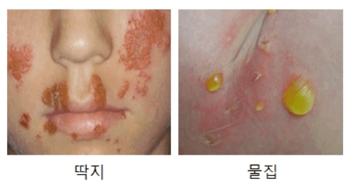 농가진