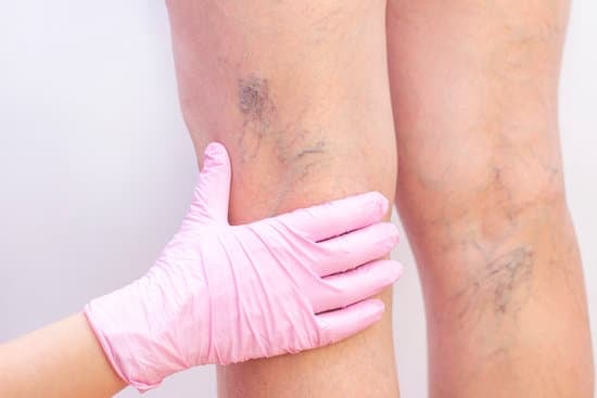 하지정맥류(Varicose Veins) – 정맥순환 문제 &amp; 치료법