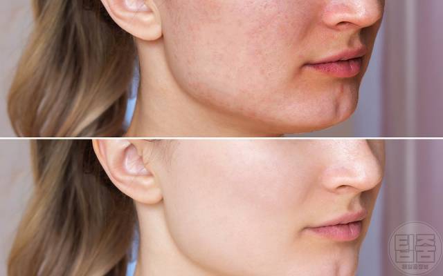 얼굴색 밝아지는법 림프마사지 효과