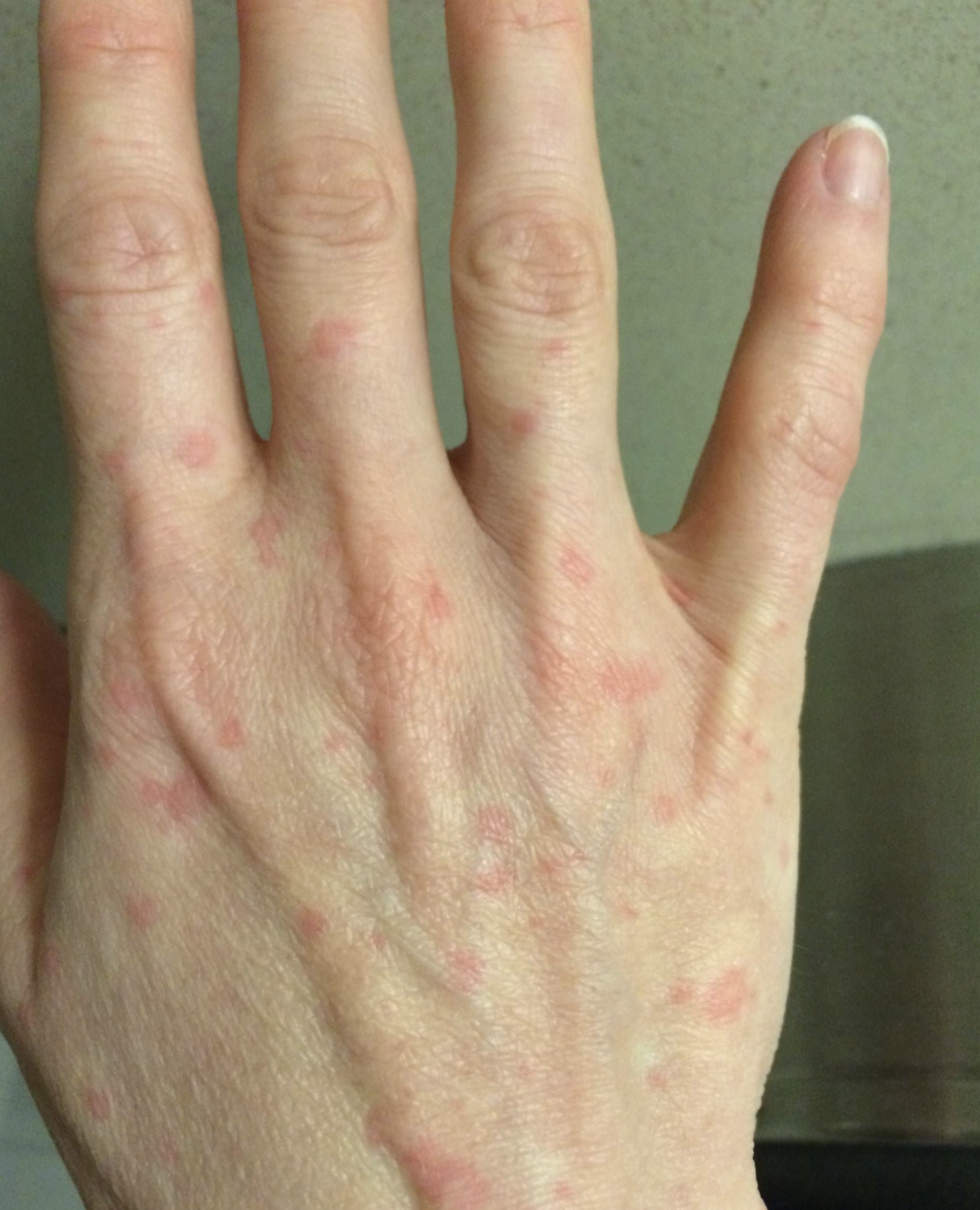 알레르기-손등