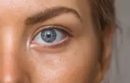 검버섯 레이저 치료 비용