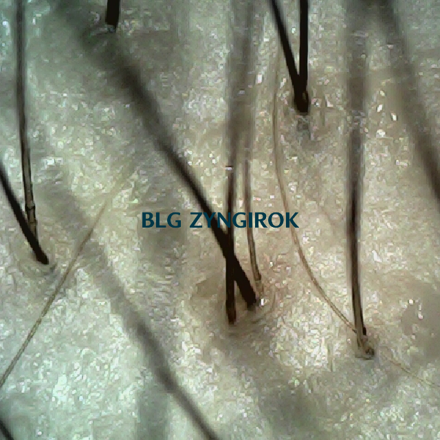 탈모 극복 프로젝트 - 정수리와 이마 사이 두피모습이다.