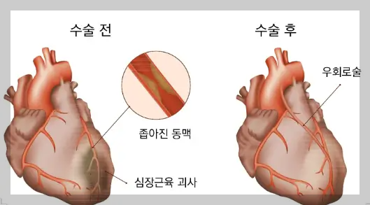 관상동맥우회술