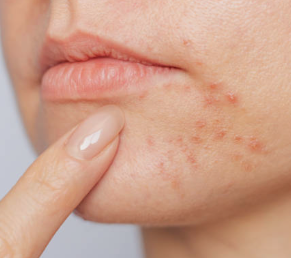 여드름 관련된 사진2