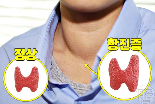 갑상선 기능 항진증 증상 갑상선기능항진증 자가진단 목에 혹 덩어리