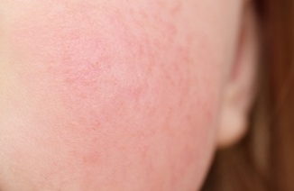 얼굴 홍조, 단순한 민감성일까? 안면홍조증 진단 기준