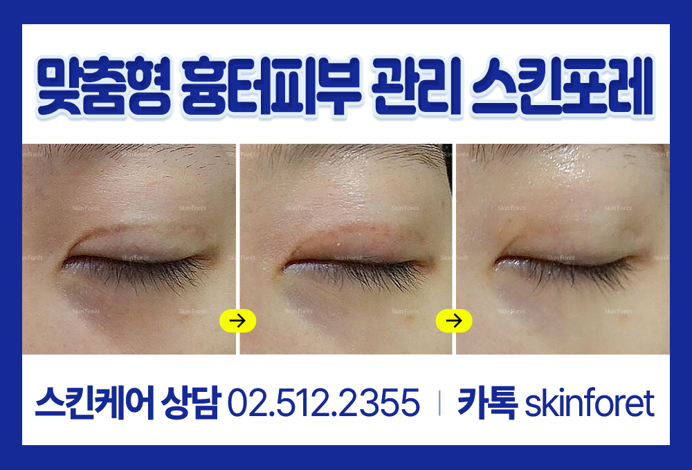 쌍꺼풀 수술과 앞트임 후 붓기 제거, 눈매 교정 케어 이미지