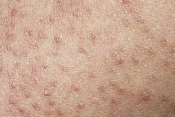 모공각화증-치료-로션-연고-가려움-사용전