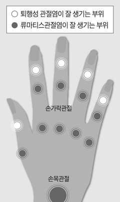 류마티스 관절염 초기증상