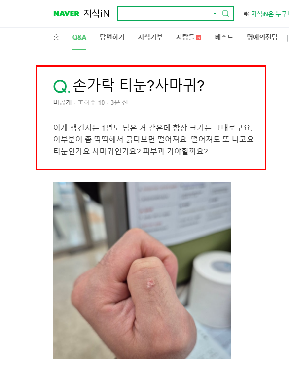 손가락 사마귀 질문