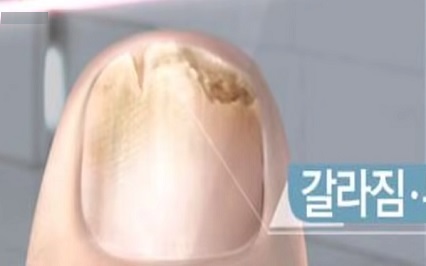 발톱 무좀 없애는 방법