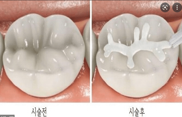 치아홈메우기&#44; sealent