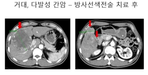 간암도 완치가 있나요?(세브란스 김도영 교수 1문 1답)