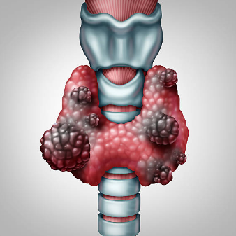 갑상선암 증상, 수술후 회복기간, 수술후 좋은음식 총정리 (2024ver)